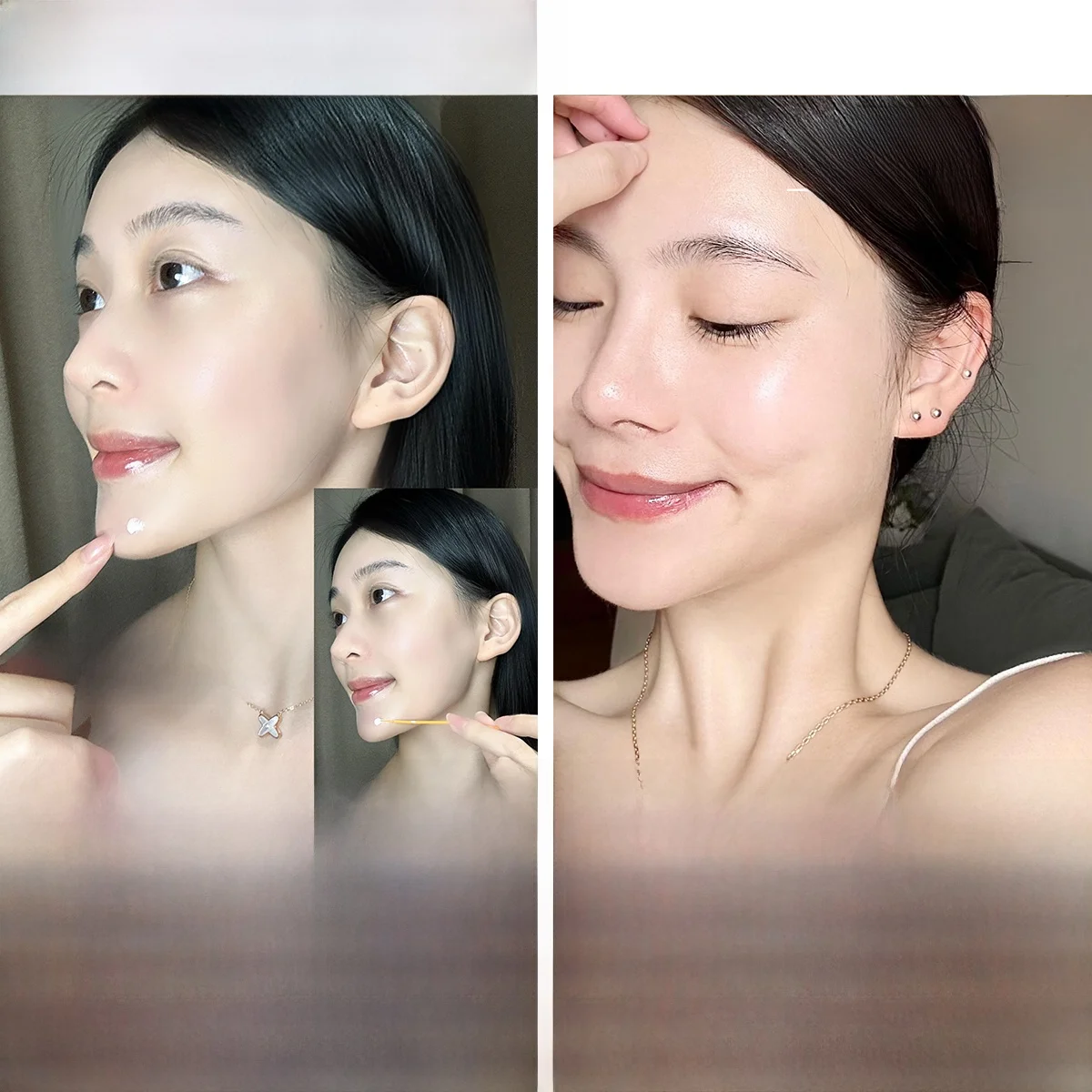 アカセラ治療とニキビ用エッセンス、どちらが本当の解決法か？