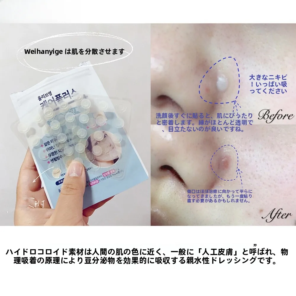 こめかみニキビに効く軽量ニキビパッチの実用性と使用シーン