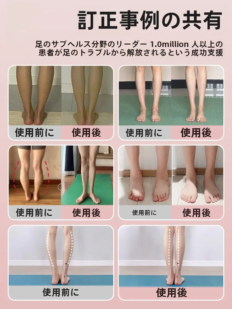 外反母趾矯正器具：アーチトレーナー矯正足指偏平足の仕組みと実用性